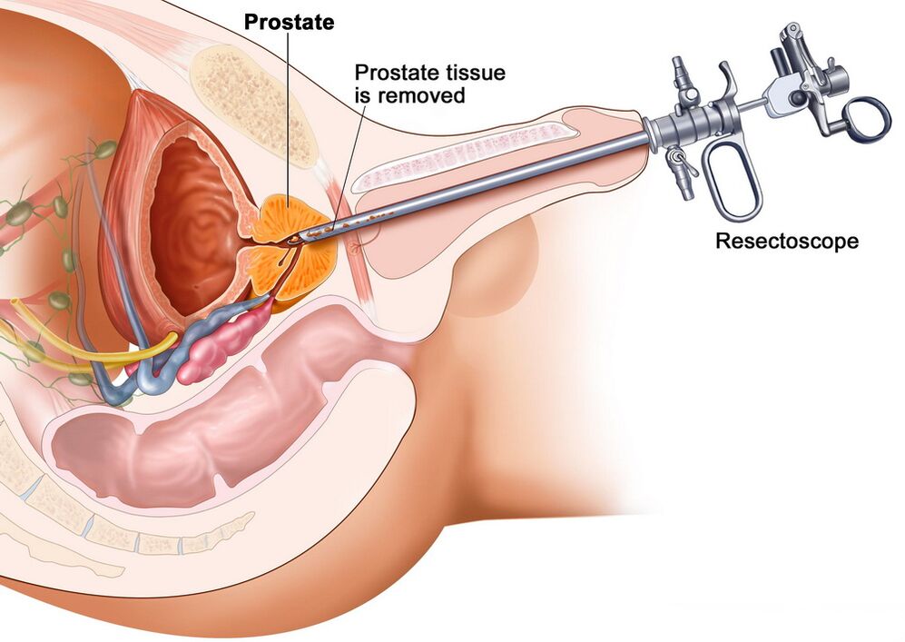 Sammlung vu Prostatagewebe fir eng korrekt Diagnostik vu Prostatitis