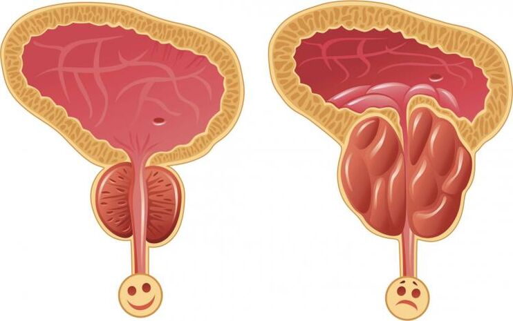 Gesond Prostates a Prostatitis